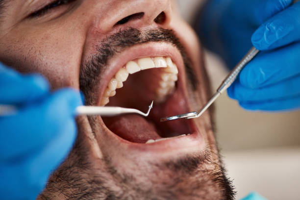 Best Emergency Treatment for Oral Infections in Monticello, LA